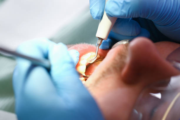 Best Emergency Wisdom Tooth Extraction in Ammon, ID