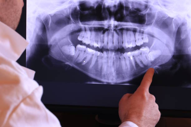 Best Knocked-Out Tooth (Avulsed Tooth) Treatment in Ammon, ID